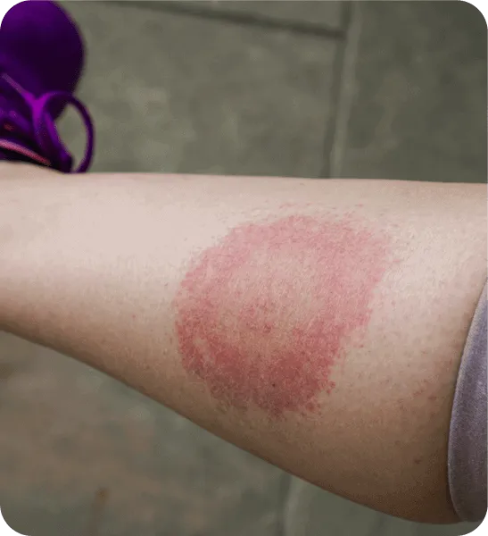 Lyme Disease